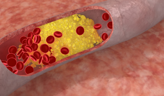 胆固醇高有什么危害？