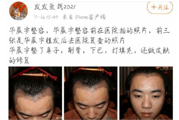 华晨宇完美人设崩塌，整容植发又出轨是怎么回事？