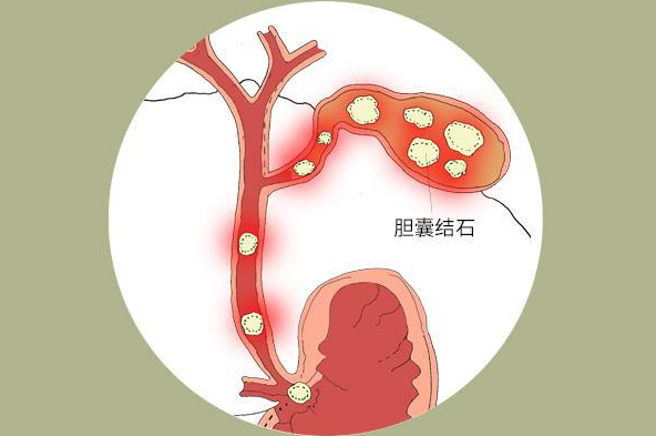 胆结石是什么原因引起的？