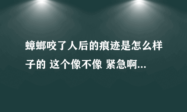 蟑螂咬了人后的痕迹是怎么样子的 这个像不像 紧急啊！！！！