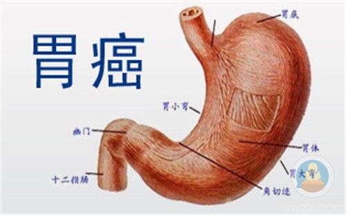 胃腺癌的晚期症状