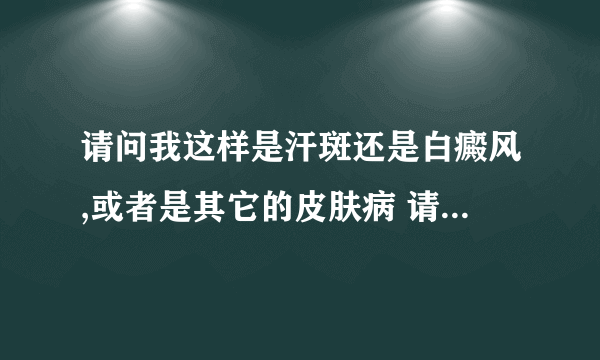 请问我这样是汗斑还是白癜风,或者是其它的皮肤病 请仔细看看图片