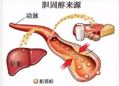 什么是高胆固醇血症